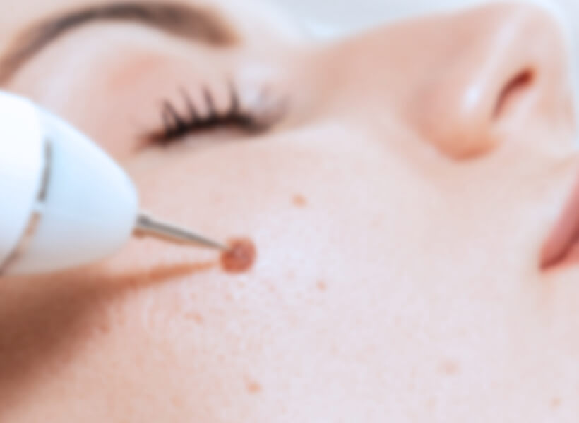 お肌のお悩みに対応したレーザー治療