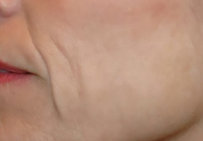 シミ（老人性色素斑）の治療 治療後