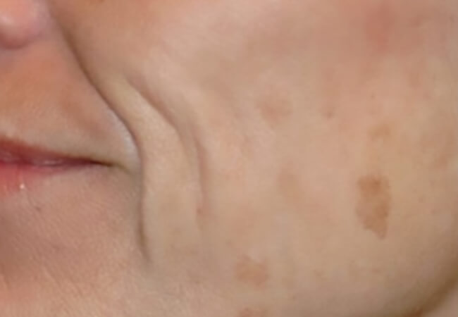 シミ（老人性色素斑）の治療 治療前