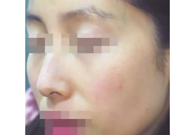 ルートロピール（美白治療、そばかすの治療）治療後