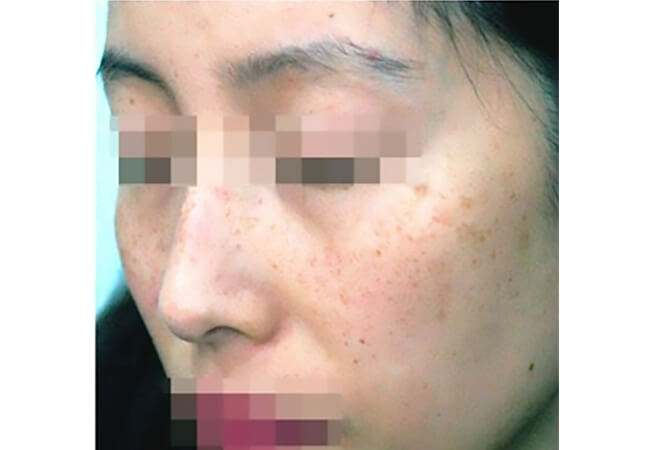 ルートロピール（美白治療、そばかすの治療）治療前