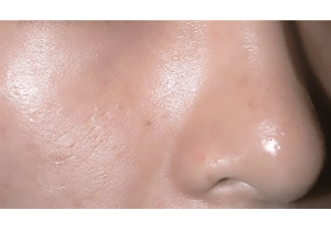 スペクトラピール（美肌治療）治療後