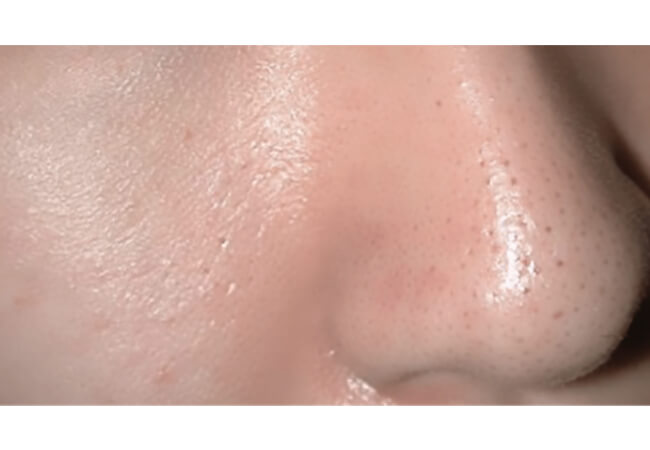 スペクトラピール（美肌治療）治療前