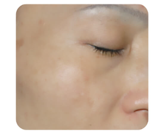 ハリウッドトーニング（レーザートーニング）治療後