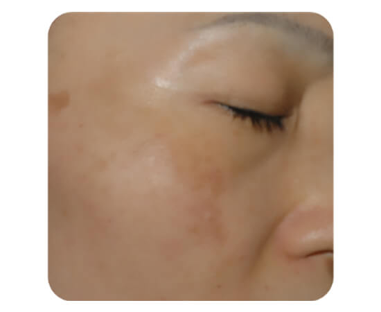 ハリウッドトーニング（レーザートーニング）治療前