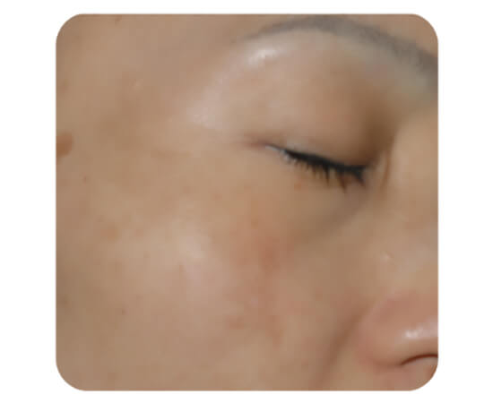 ハリウッドトーニング（レーザートーニング）治療中