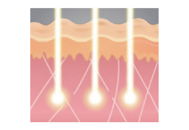 ハリウッドフラクショナル（YAGフラクショナル）　レーザー照射