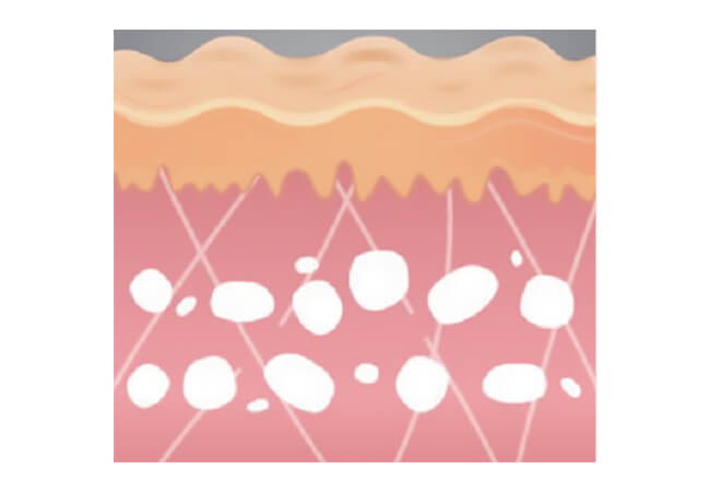 ハリウッドフラクショナル（YAGフラクショナル）　真皮での空洞形成